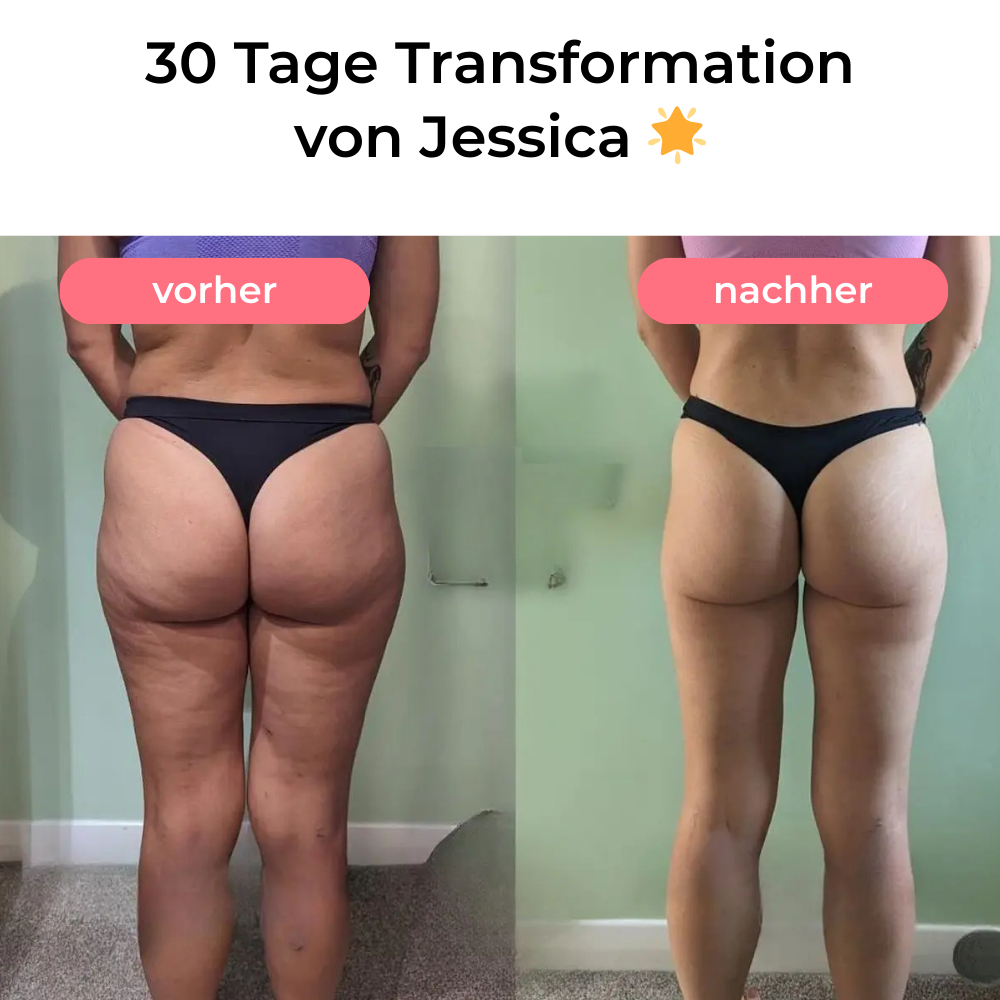 Steinsee Cellulite Massage Pro